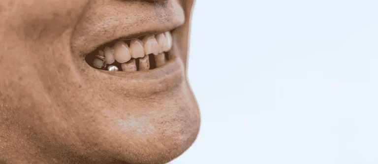 All-On-X Dental Implant Candidacy In Plano, Tx