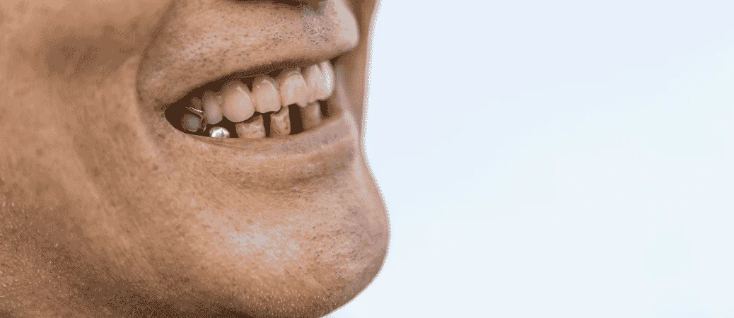 How To Know If You’Re A Candidate For All-On-X Dental Implants In Plano, Tx
