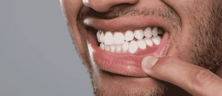 Gum Recession Treatment Options