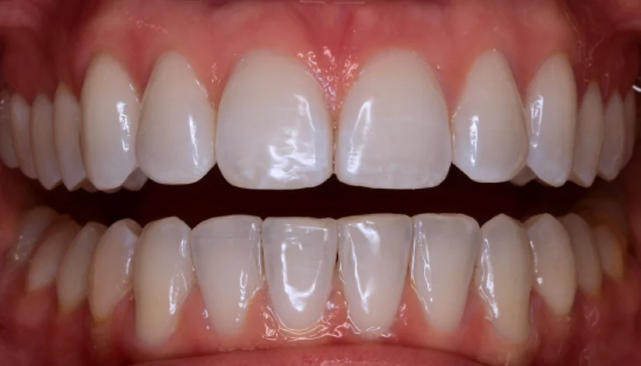 Smile Gallery 01 After
