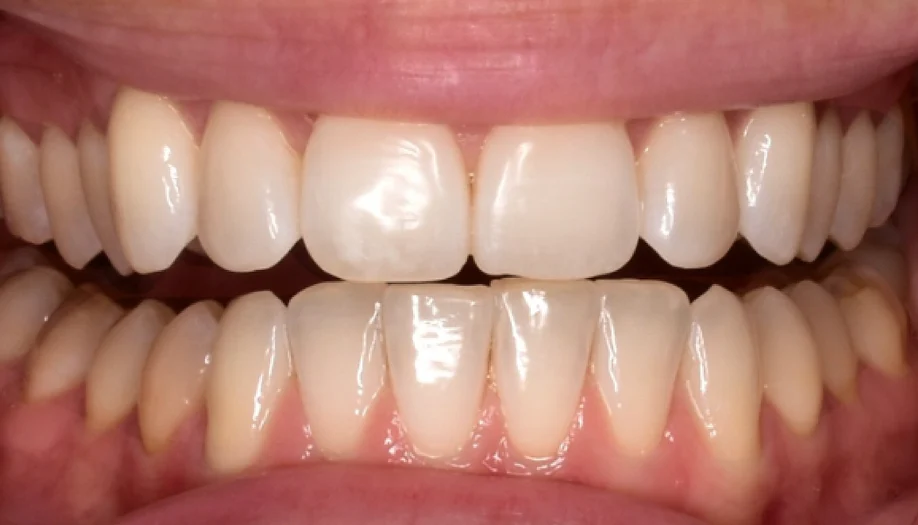 Smile Gallery 01 Before
