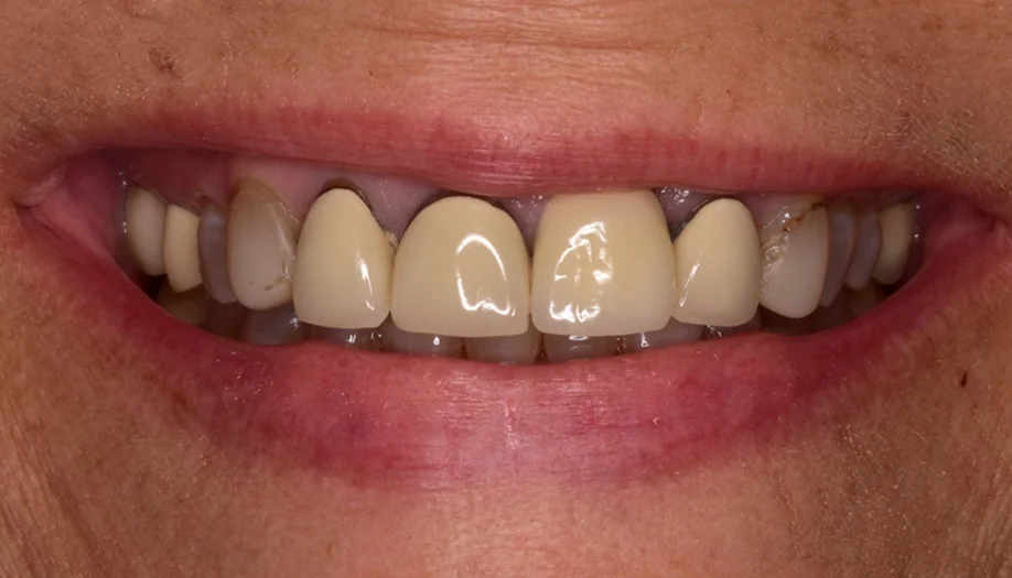 Smile Gallery 02 Before