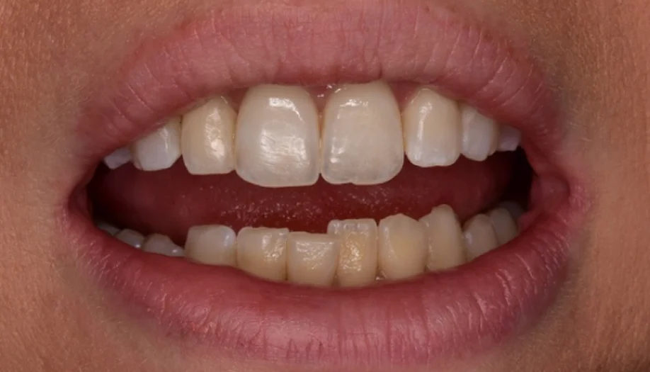 Smile Gallery 06 Before