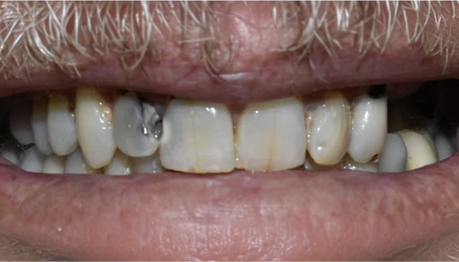 Smile Gallery 07 Before