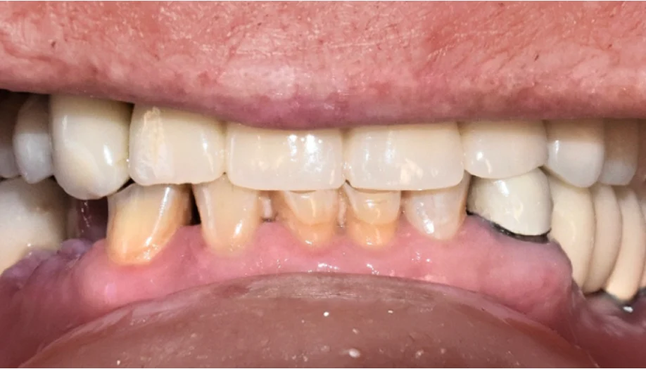 Smile Gallery 10 Before
