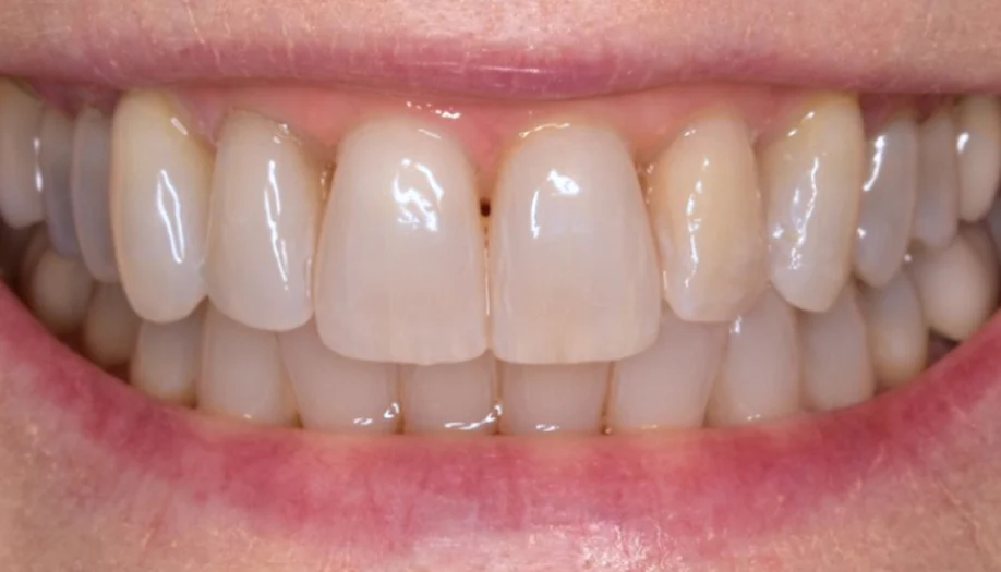 Smile Gallery 11 After