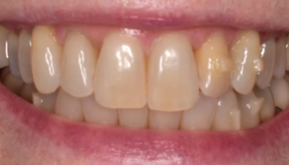 Smile Gallery 11 Before