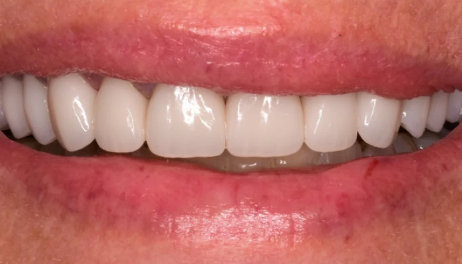 Smile Gallery 12 After