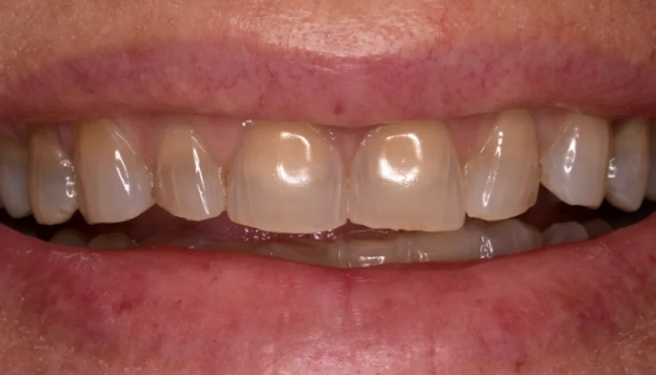 Smile Gallery 12 Before