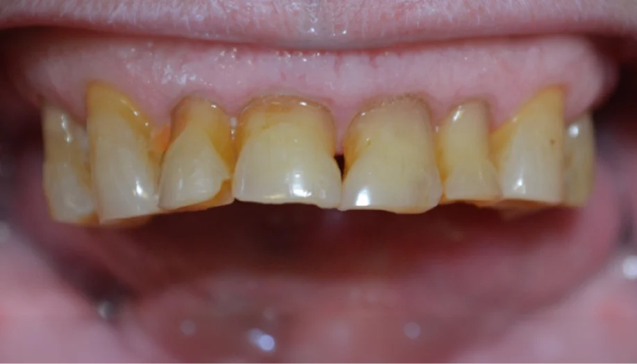 Smile Gallery 13 Before