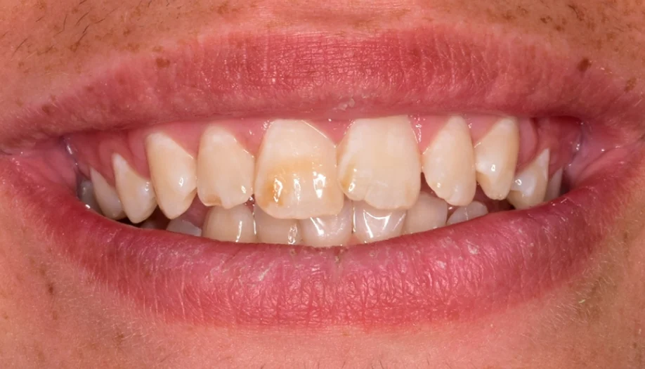 Smile Gallery 14 Before