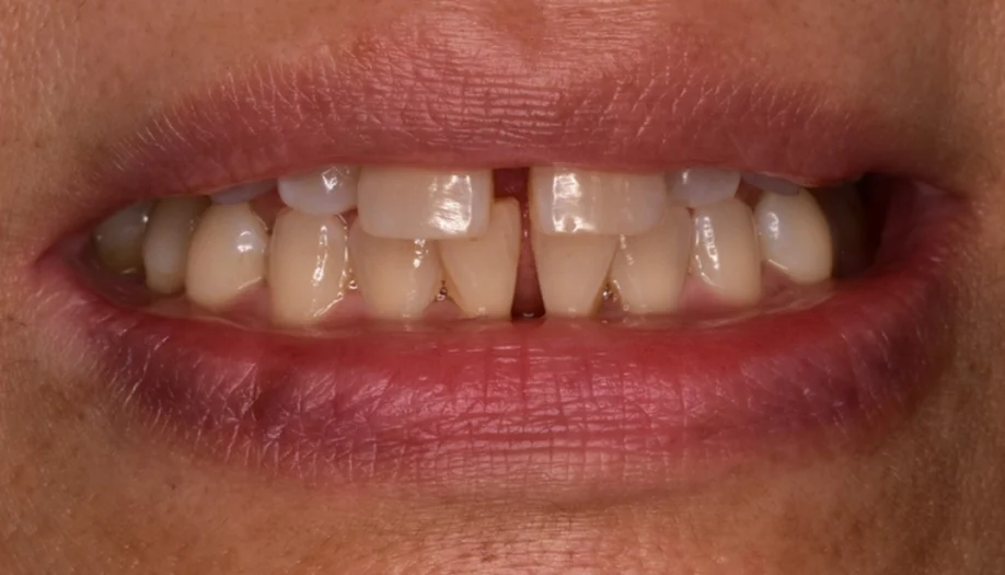 Smile Gallery 15 Before