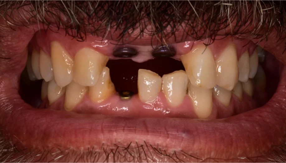 Smile Gallery 17 Before