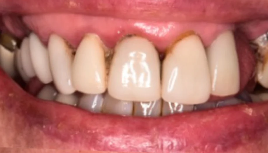 Smile Gallery 18 Before