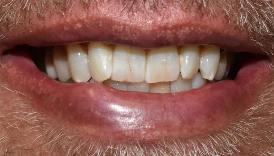 Smile Gallery 19 Before