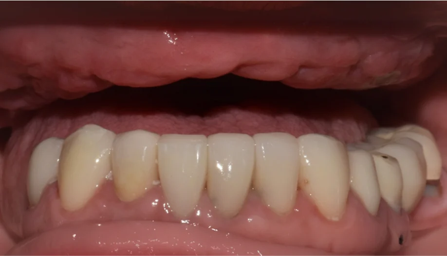 Smile Gallery 23 Before