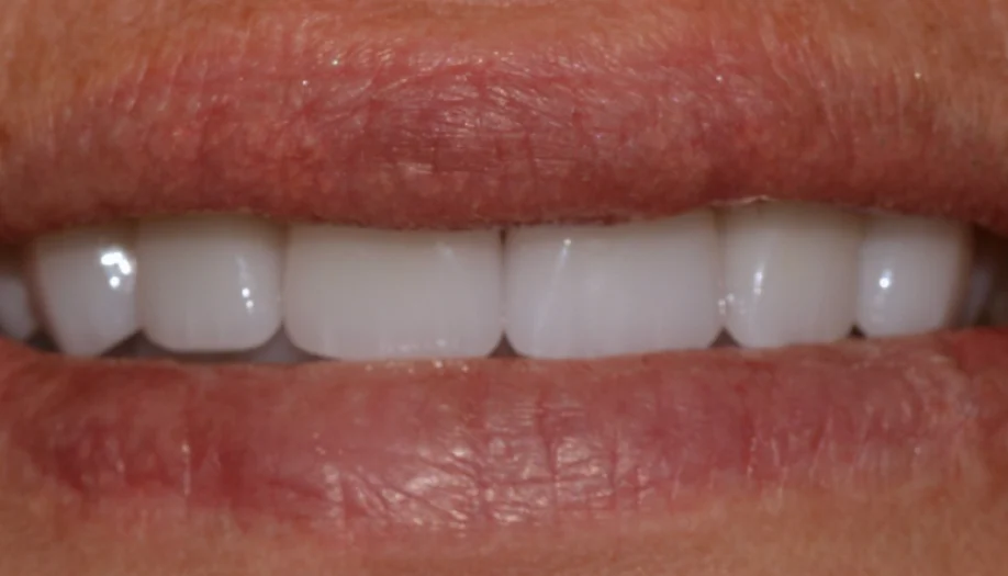 Smile Gallery 24 After