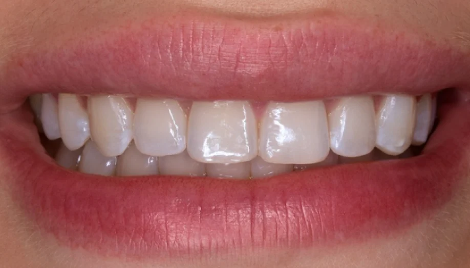 Smile Gallery 25 After