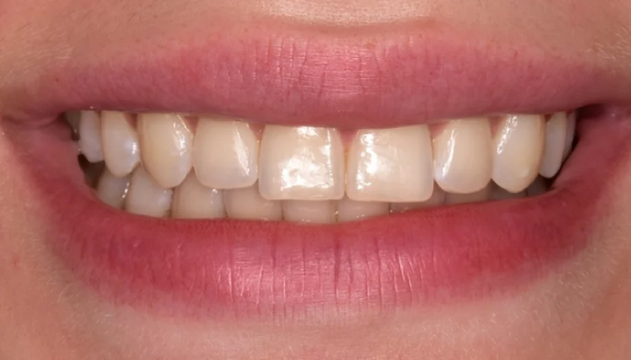 Smile Gallery 25 Before