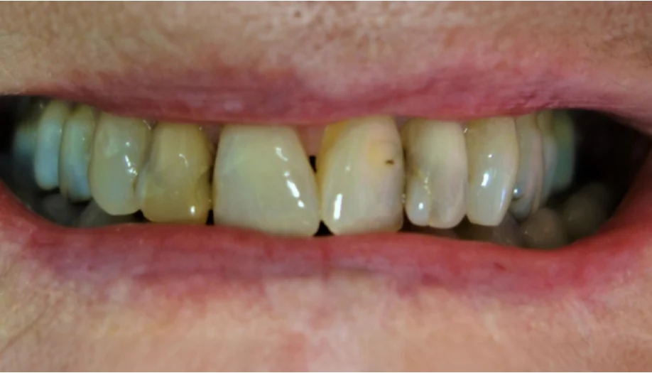 Smile Gallery 26 Before
