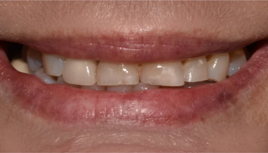 Smile Gallery 27 Before