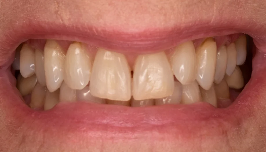 Smile Gallery 28 Before
