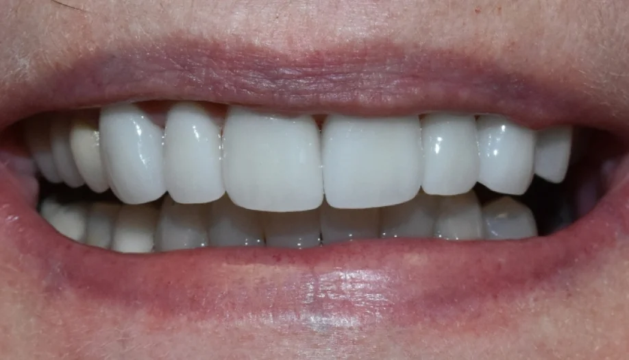 Smile Gallery 30 After