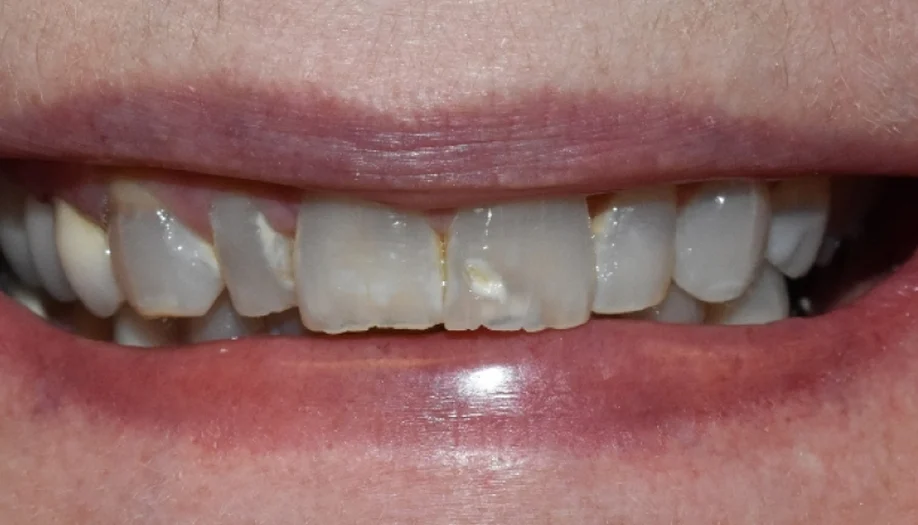 Smile Gallery 30 Before