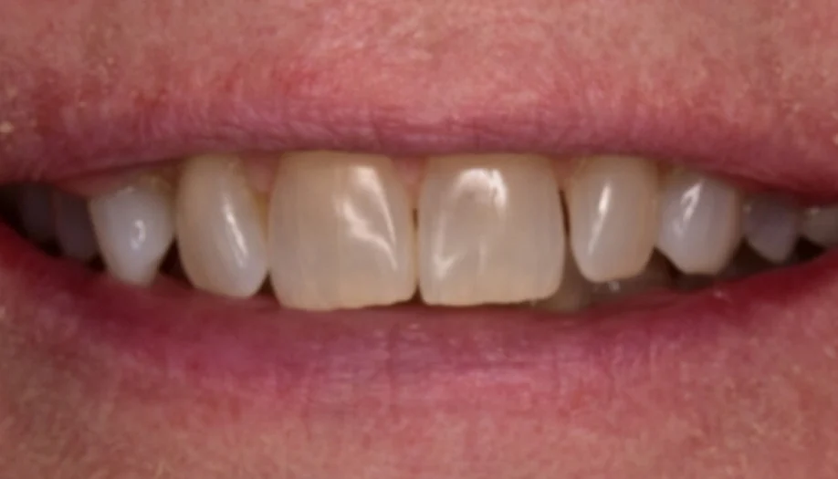 Smile Gallery 31 Before