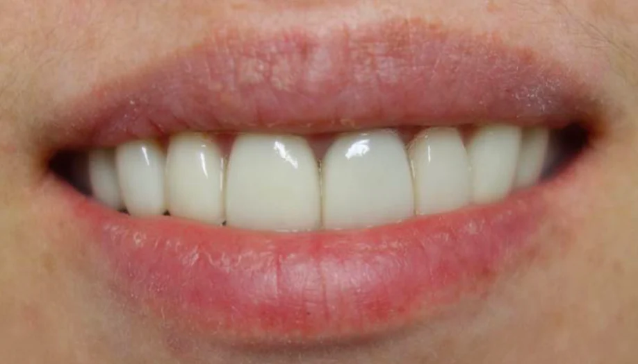 Smile Gallery 32 After