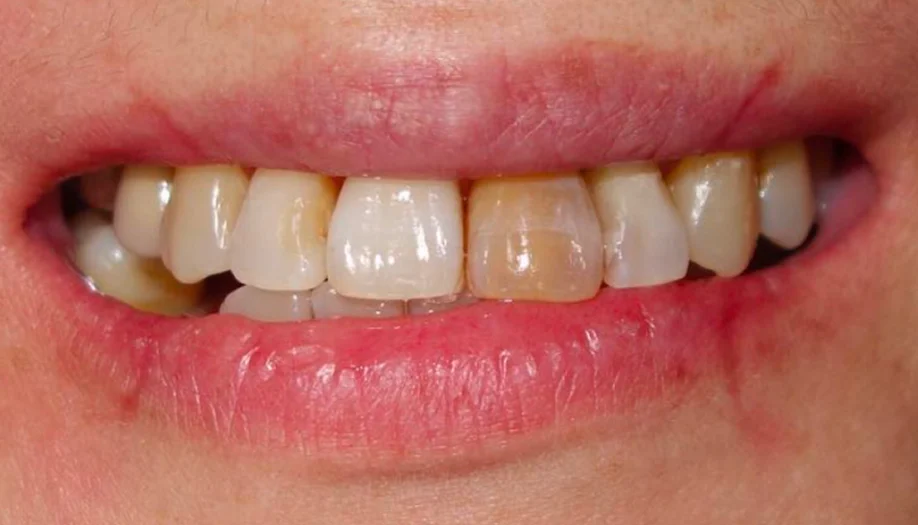 Smile Gallery 32 Before