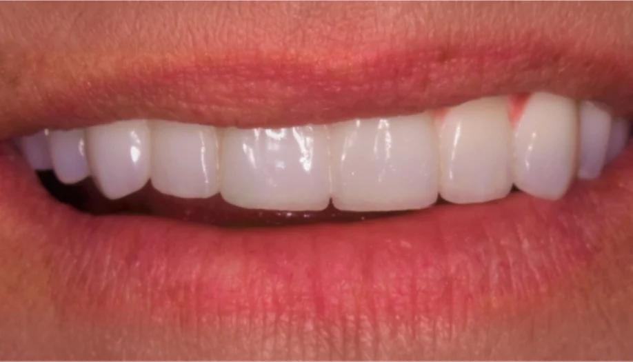 Smile Gallery 35 Before