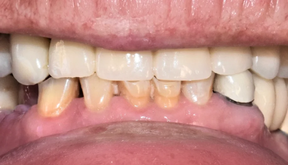 Smile Gallery 37 Before